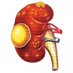 Kidney abscess