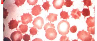 Acanthocytosis of red blood cells