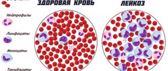 Анализ крови при лейкозе
