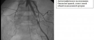 angiographic study - occlusion of the right, stenosis of the left common iliac artery