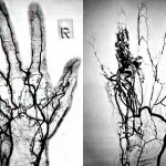 Angiography of the hands photo images