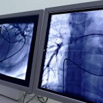 Coronary artery bypass surgery in Germany