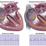 Heart arythmy