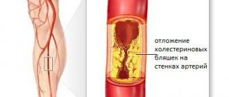Atherosclerosis of the lower extremities