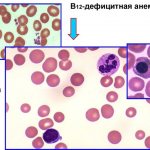 B12 anemia