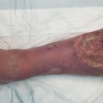 Large trophic ulcer on the leg