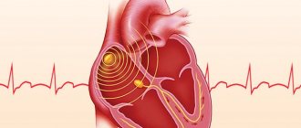 Bradycardia with low heart rate