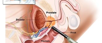 Diagnosis of prostate cancer in Germany