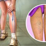 Diet for deep vein thrombosis of the lower extremities, cleansing blood vessels from blood clots