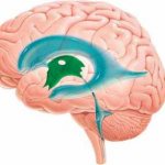 Dilatation of the lateral ventricles of the brain