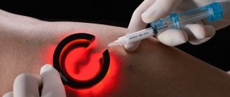 Diode fluorescent sclerotherapy