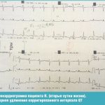 Patient electrocardiogram