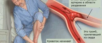 Embolism is one of the common causes of acute arterial insufficiency