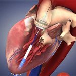 Endovascular aortic valve replacement