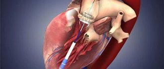 Endovascular aortic valve replacement