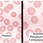Red blood cells are normal and with anemia, macrocytosis and hyperchromia