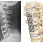 Fixation of the cervical vertebrae