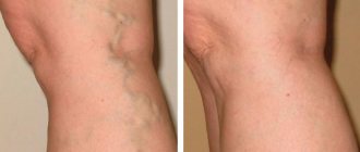 Phlebectomy - surgery for varicose veins through punctures without incisions