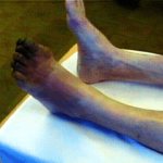 Gangrene of left toes
