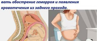 Hemorrhoids during pregnancy