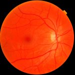 гипертоническая ретинопатия