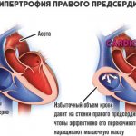 right atrial hypertrophy