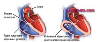 right atrial hypertrophy
