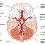 Arterial hypoplasia