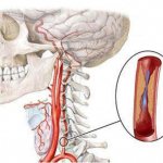 Гипоплазия правой и левой позвоночной артерии