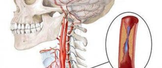Гипоплазия правой и левой позвоночной артерии