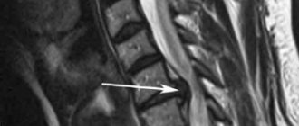 Cervical hernia on MRI.