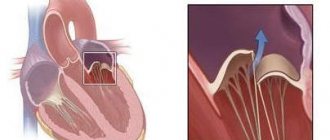 Хроническая ревматическая болезнь сердца