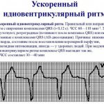 Idioventricular rhythm on the ECG. What does this mean, photos, causes and treatment 