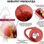 инфаркт-миокарда