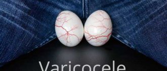 How to determine the appearance of varicocele