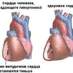 What does the heart of a person with hypertension look like?
