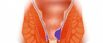 How to cure external hemorrhoids in pregnant women