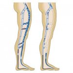 What operations are performed for varicose veins in the legs?