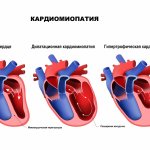 Cardiomyopathy disease.jpg