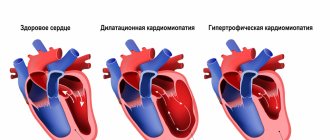 Cardiomyopathy disease.jpg