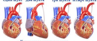 Coronary artery bypass surgery