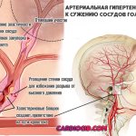 Cerebral hemorrhage: causes and treatment, signs of the acute stage and precursor symptoms, consequences and prognosis