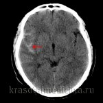 КТ головного мозга. Кровь в субарахноидальных ликворных пространствах справа. (фото Вишняков В.Н.)