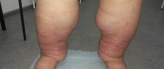 Treatment of lymphedema