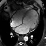 MRI of the heart, what shows