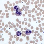 Neutrophils in a blood smear