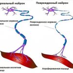 Нормальный и повреждённый нейрон