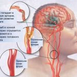 complications of carotid artery disease
