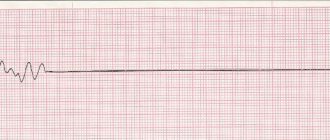 Cardiac arrest on ECG