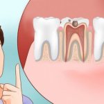 Острая зубная боль. Что делать, если болит зуб